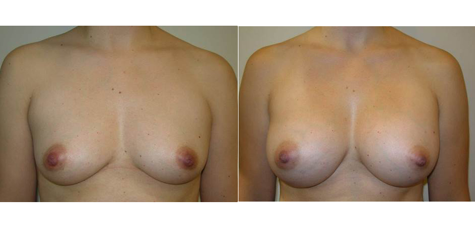 Breast Augmentation Before & After Photo