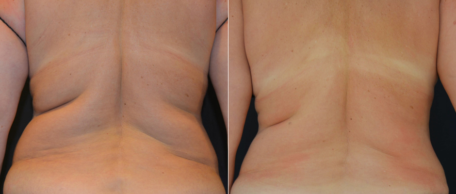 CoolSculpting for Women Before & After Photo