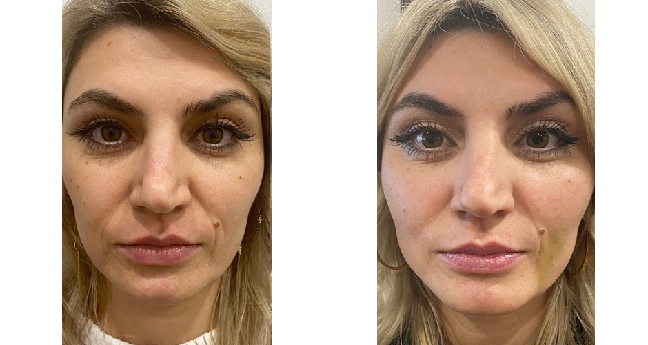 Thread Lift Before & After Photo